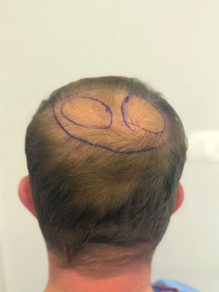 Trapianto capelli Ruggeri Medical a Tirana — fase 1 di 12