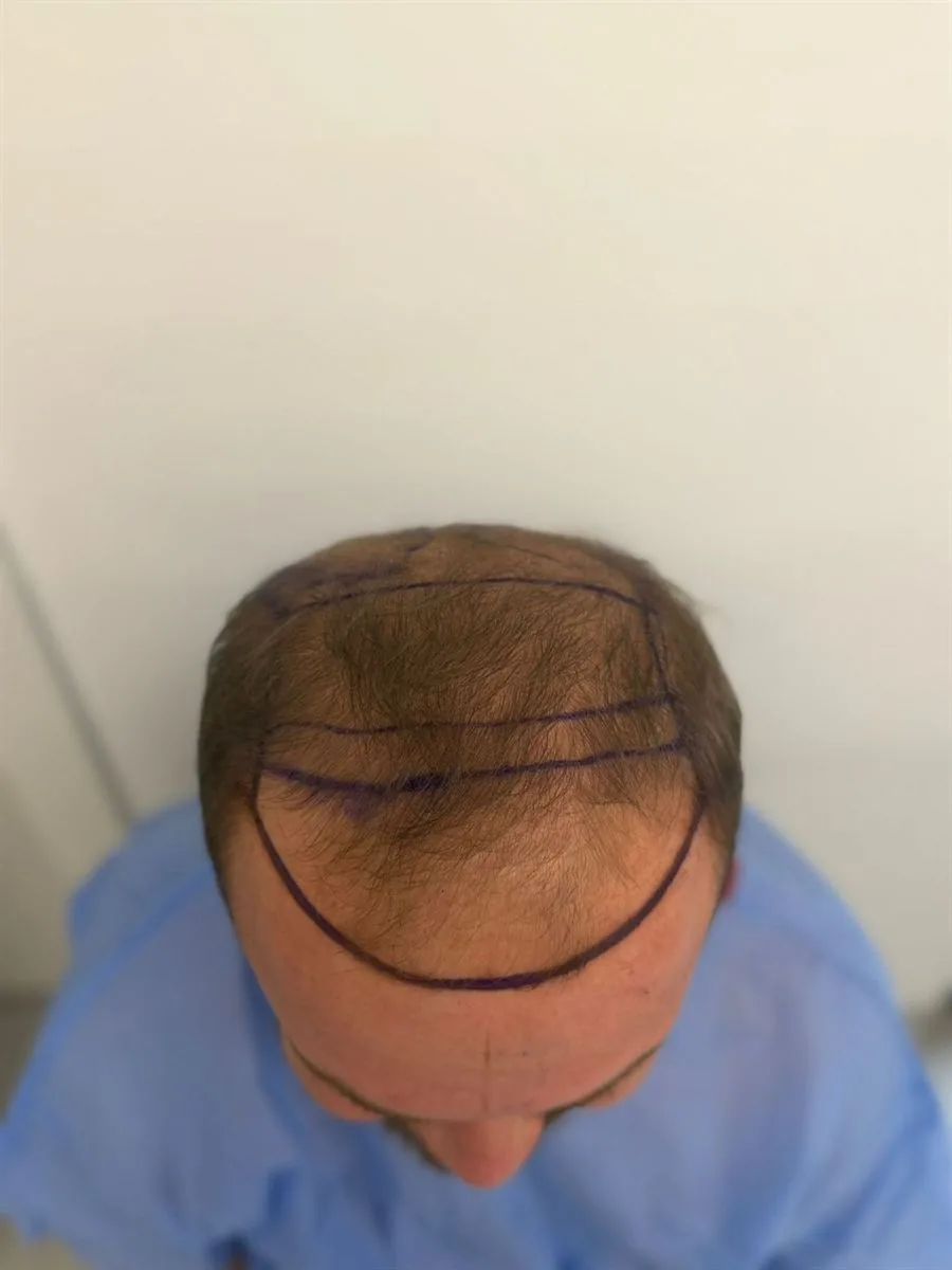 Trapianto capelli Ruggeri Medical a Tirana — fase 2 di 12