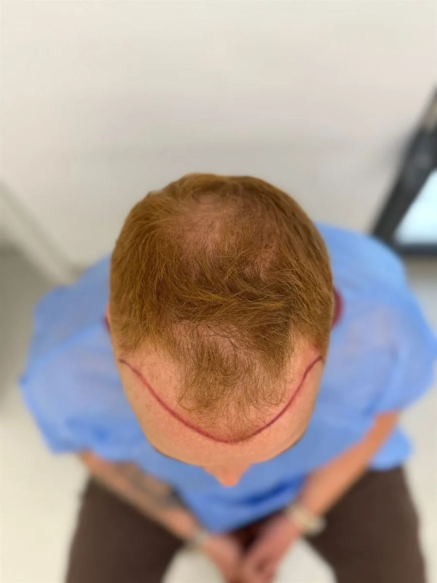 Trapianto capelli Ruggeri Medical a Tirana — fase 3 di 12
