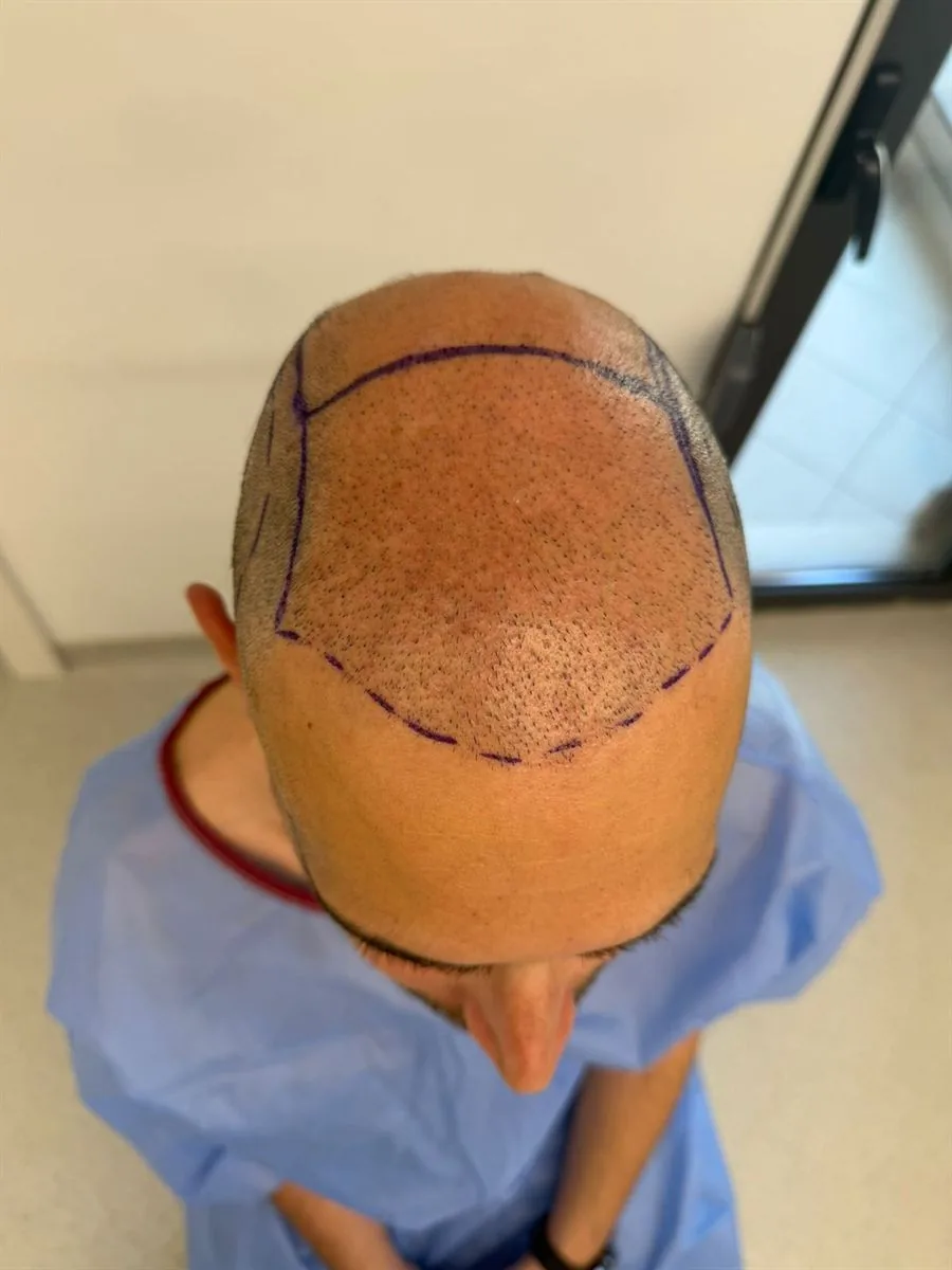 Trapianto capelli Ruggeri Medical a Tirana — fase 4 di 12