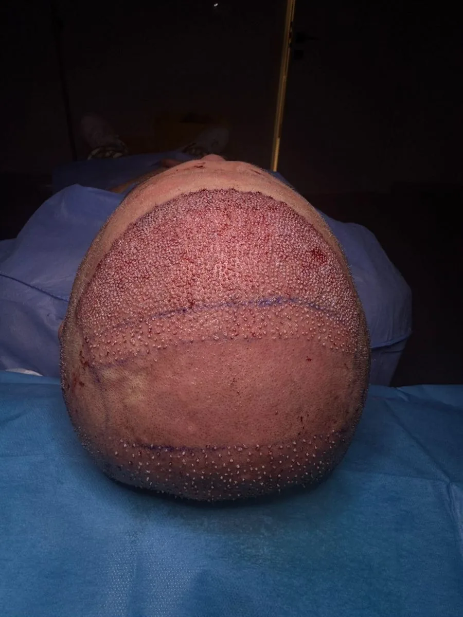 Trapianto capelli Ruggeri Medical a Tirana — fase 6 di 12