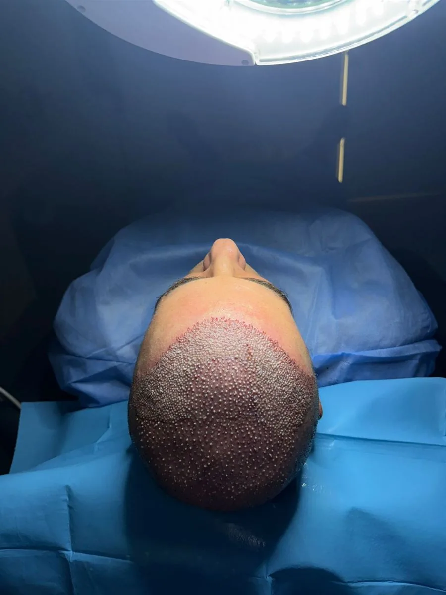 Trapianto capelli Ruggeri Medical a Tirana — fase 8 di 12