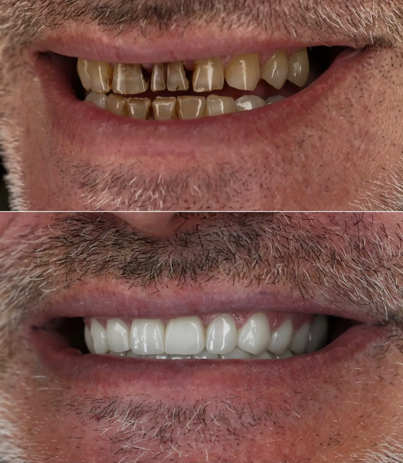 Prima e dopo di un trattamento con faccette dentali