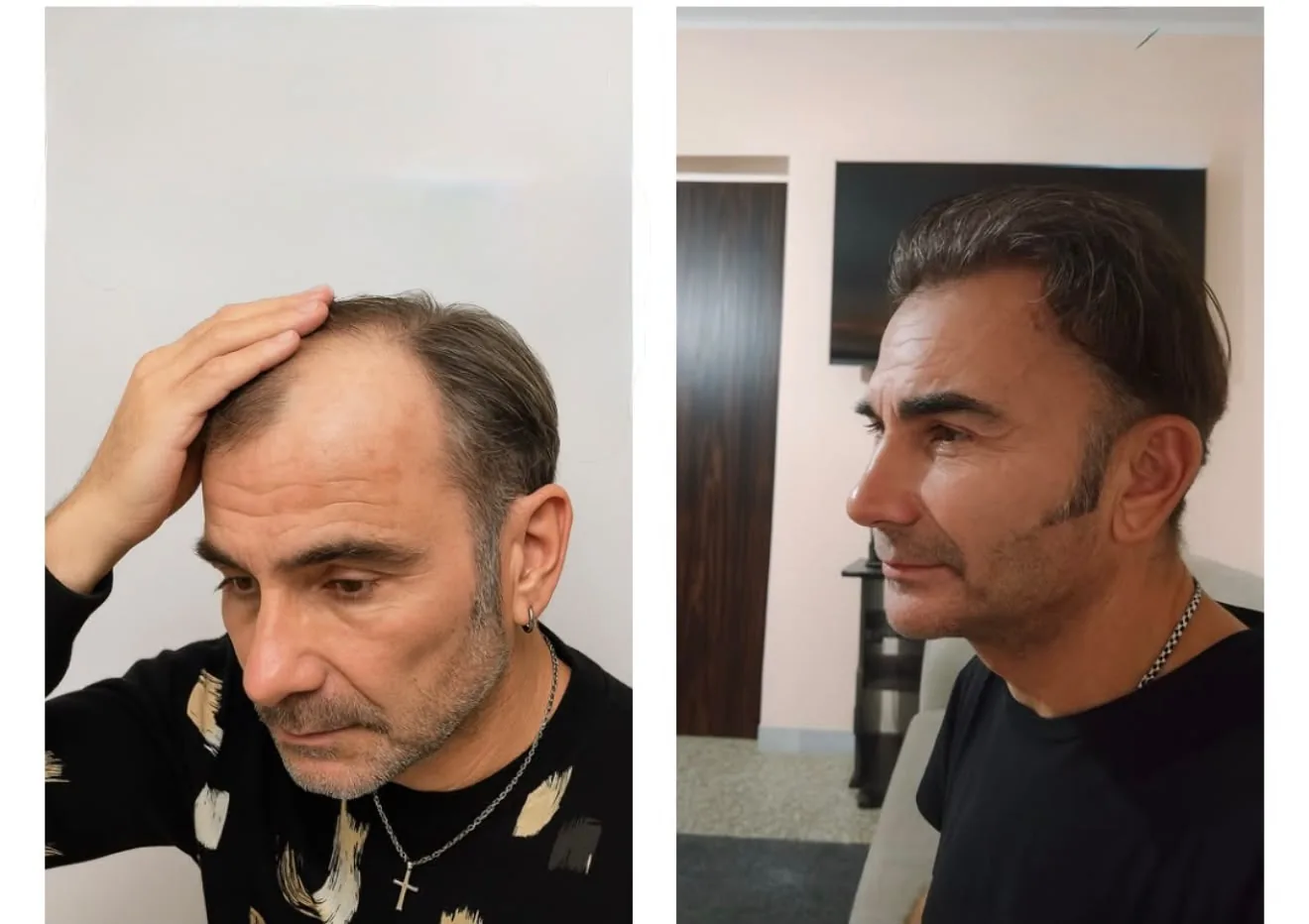 Trapianto capelli: risultato prima e dopo di un paziente Ruggeri Medical